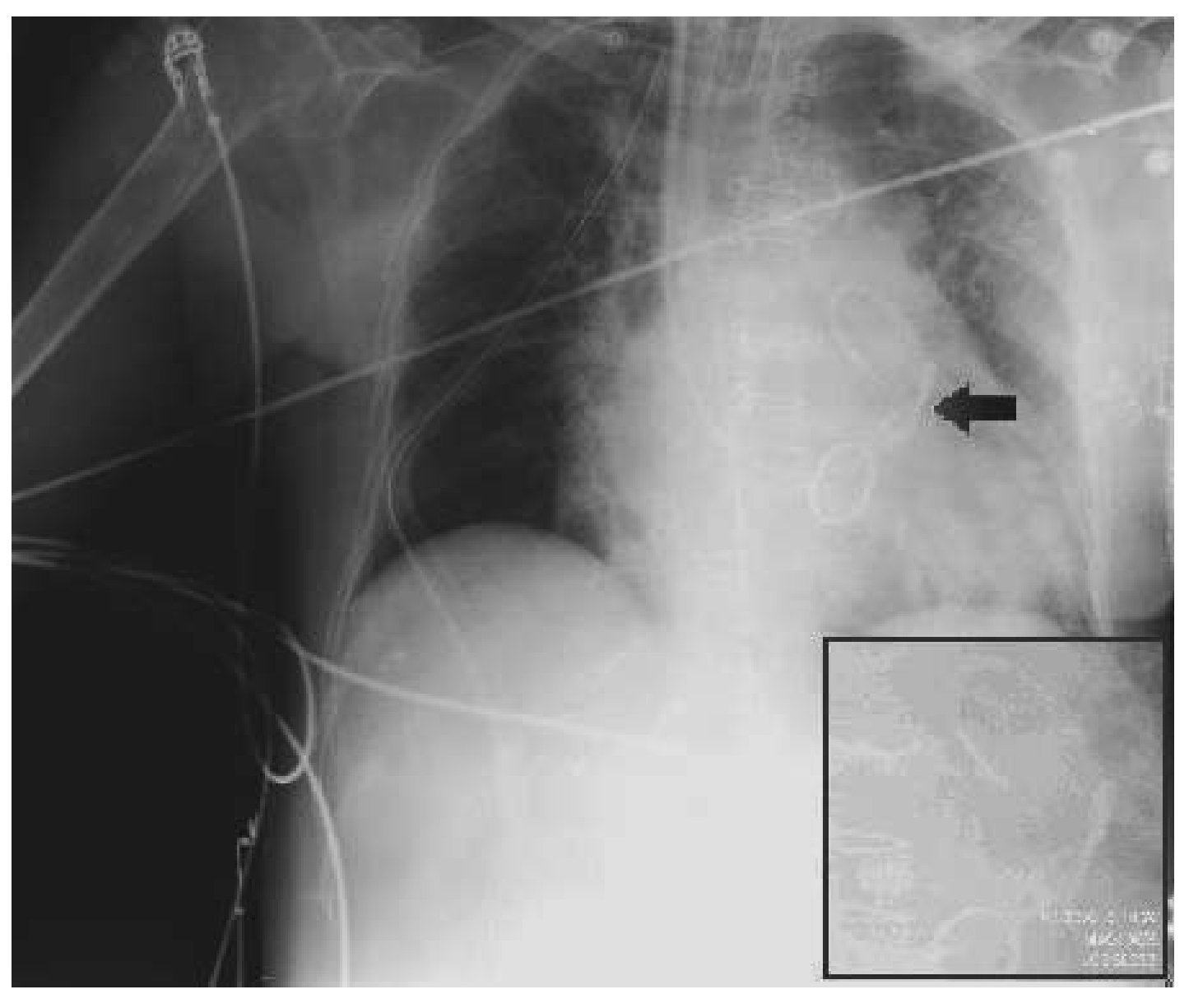 Multiple Knotting Of A Swan-ganz Catheter 