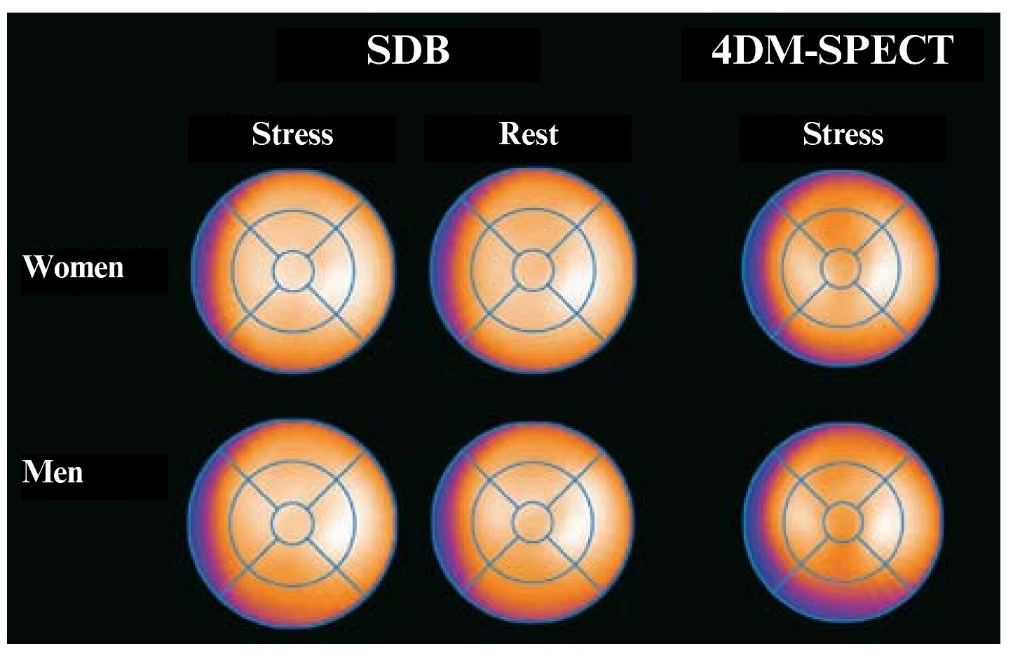 Normal Myocardial Perfusion Spect Database For The Spanish Population Revista Española De 6928