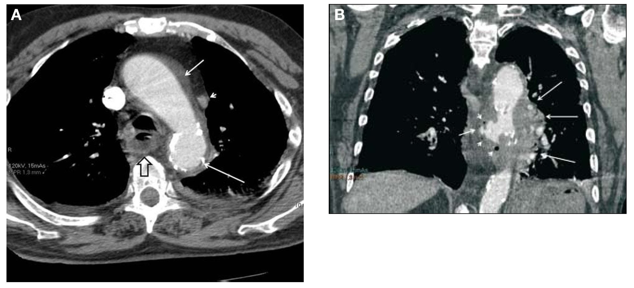 Aortoesophageal Fistula Due to a Penetrating Aortic Ulcer | Revista ...