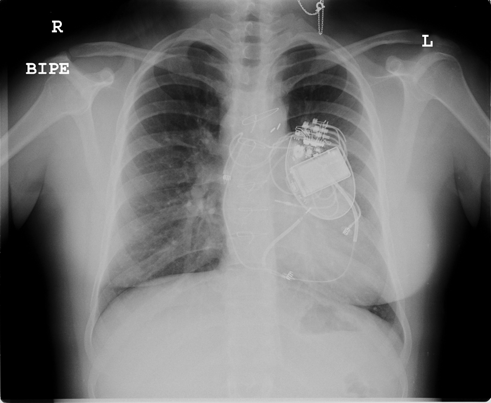 Biventricular Cardioverter-Defibrillator Implantation in a Patient With ...