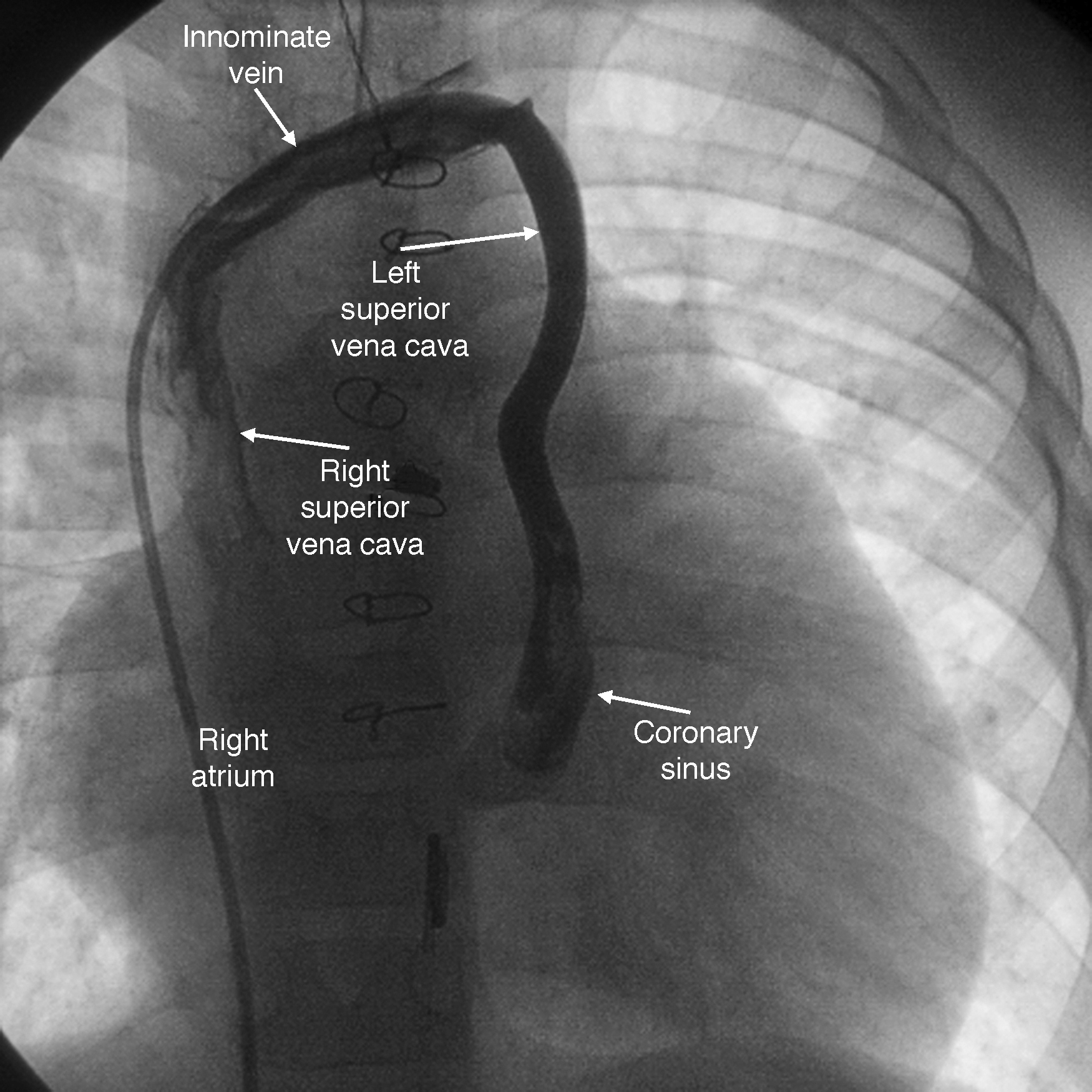 Coronary Sinus Orifice Atresia | Revista Española de Cardiología