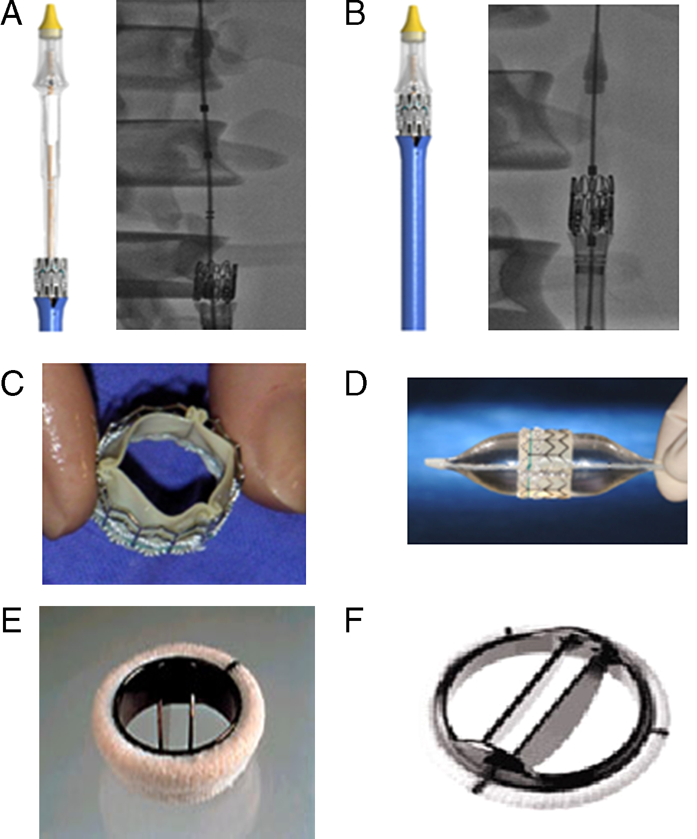 Transcatheter Aortic Valve Implantation in Patients With a Mechanical ...