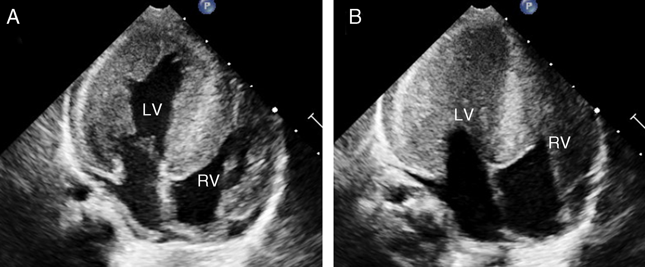 When Should We Start Enzyme Replacement Therapy for Infantile Pompe ...