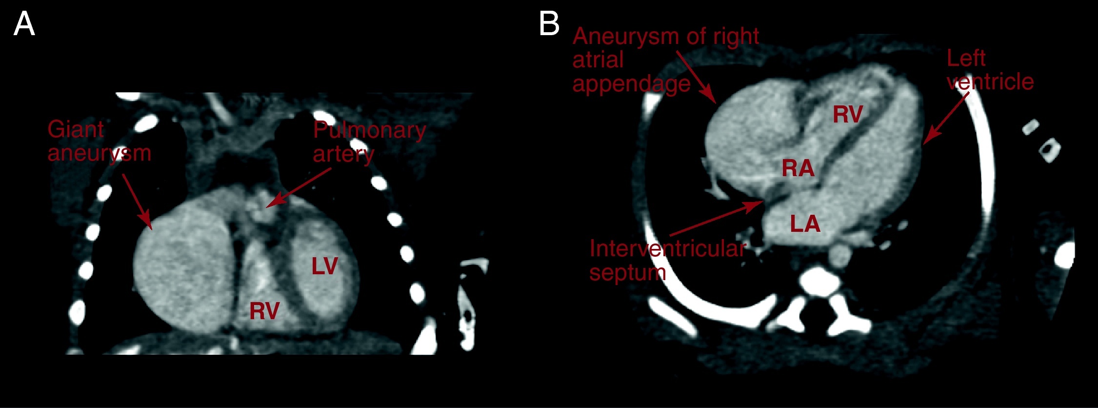 Congenital Aneurysm of the Right Atrial Appendage in a Newborn: a Rare ...