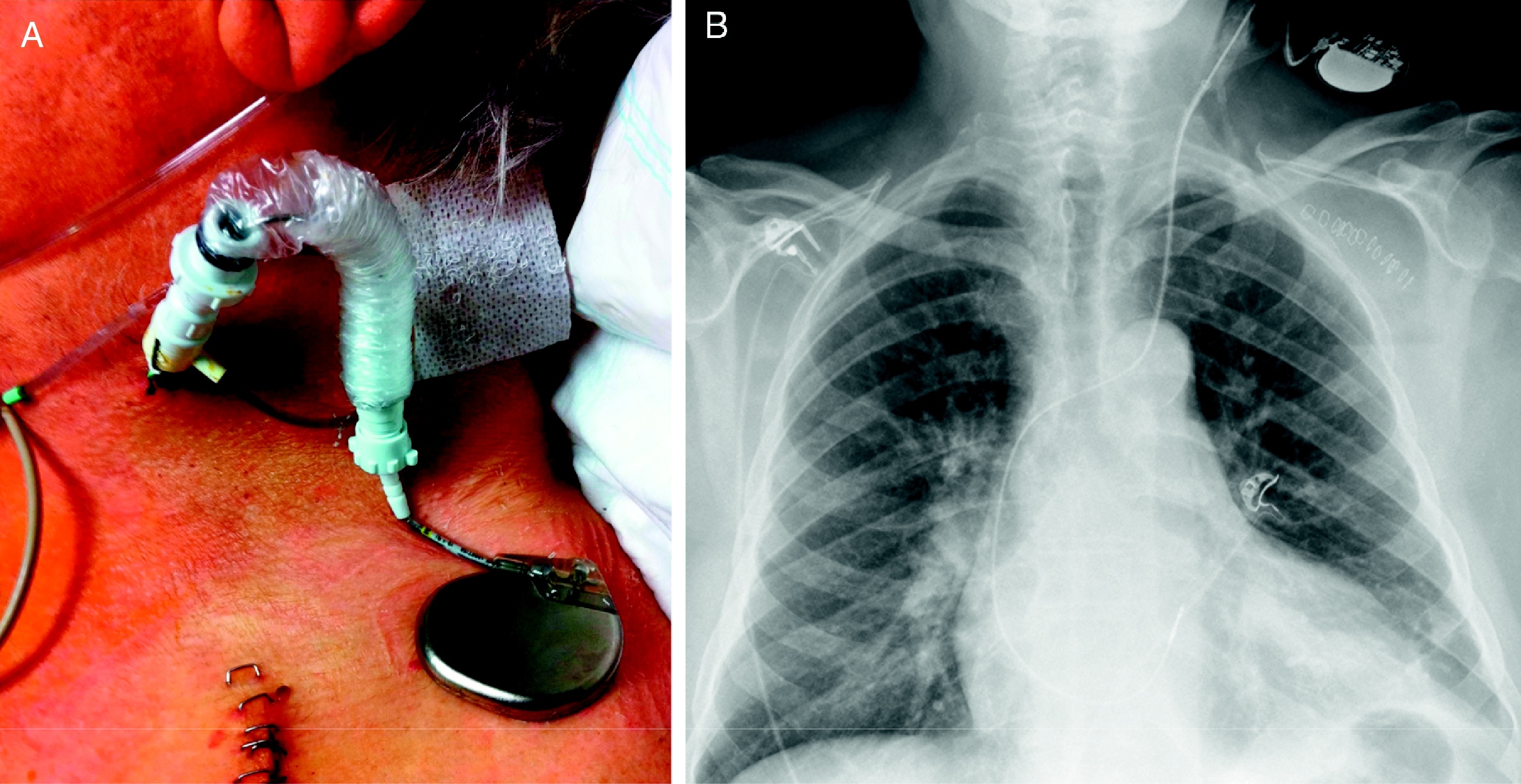 Prolonged Temporary Cardiac Pacing Using an External Permanent Pacing ...