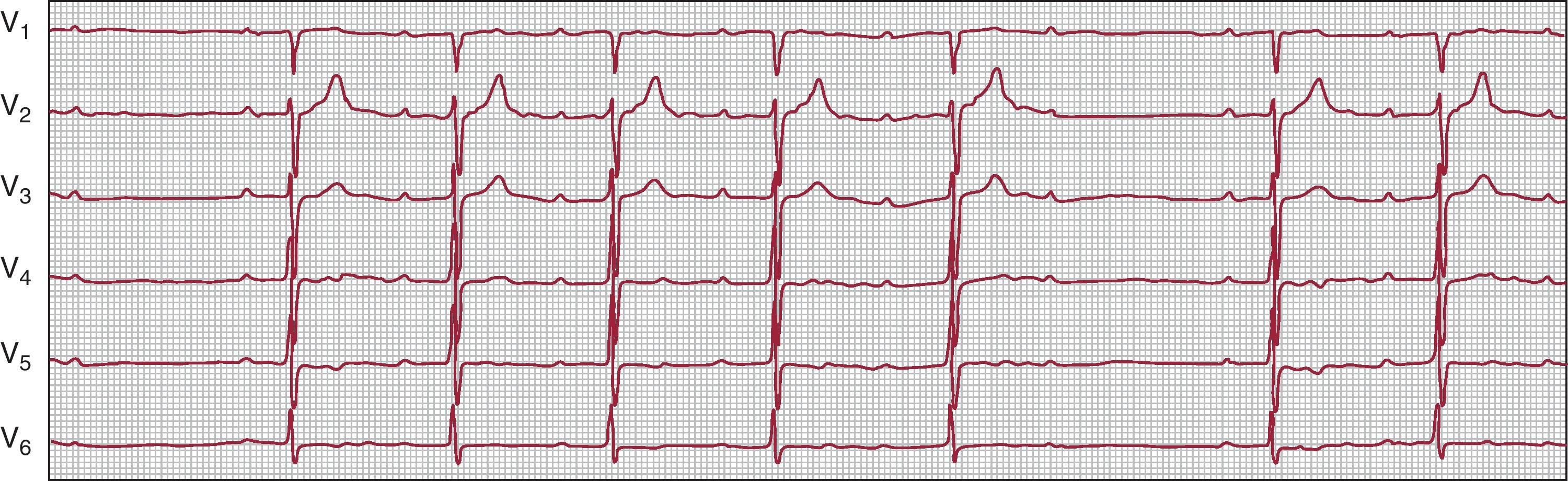Bradyarrhythmias and Conduction Blocks - Revista Española de ...