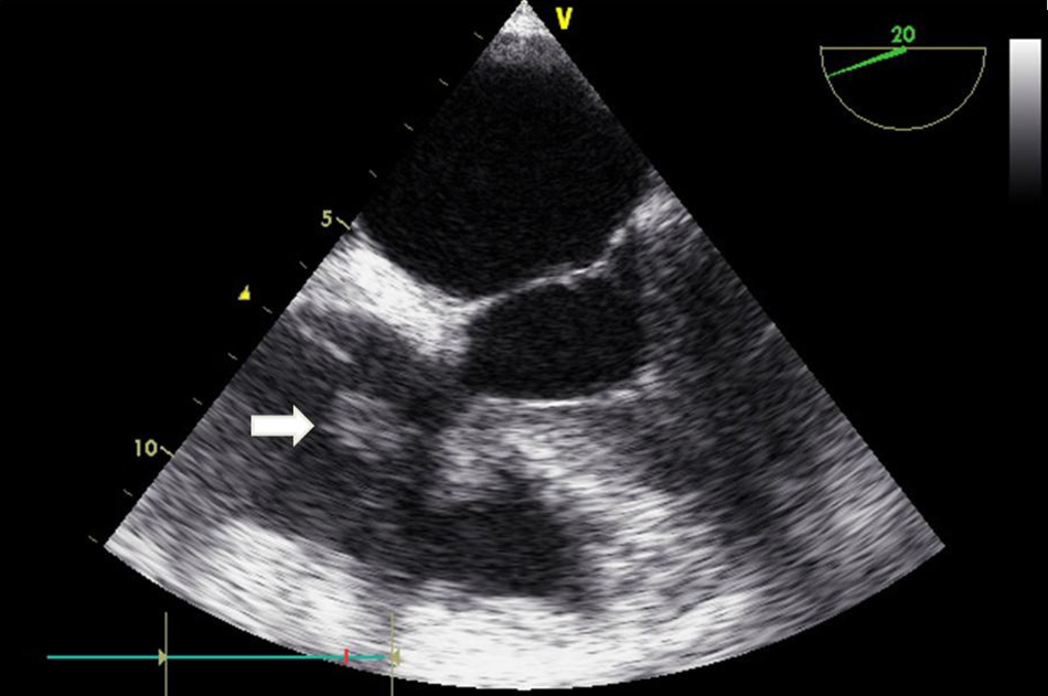 Transient Trifascicular Block Secondary to Tricuspid Valve