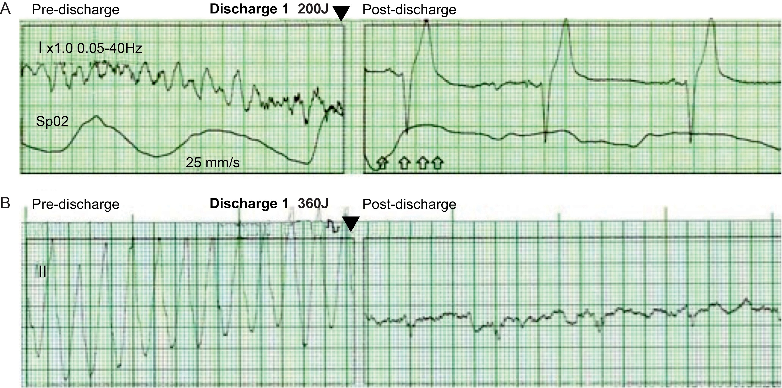Malignant Ventricular Arrhythmias During Surgical Procedures for ...