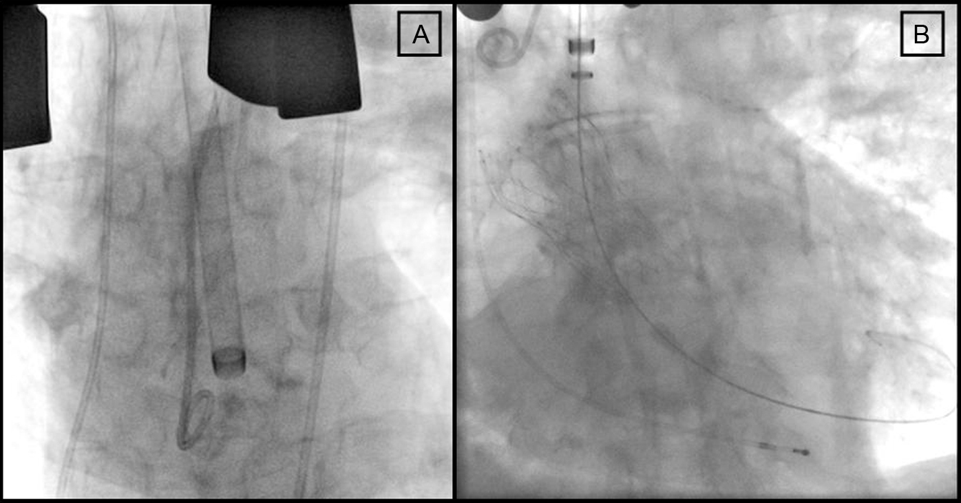 Direct Transaortic Access For Transcatheter Aortic Valve Implantations