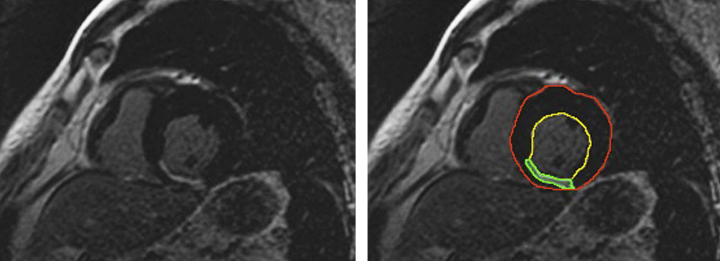 A Prominent R Wave in V 1 but not in V 2 Is a Specific Sign of a Large ...