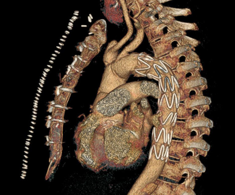 Hybrid Treatment for Acute Aortic Arch Dissection