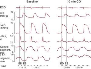 Example of electrocardiogram, hemodynamic, and segment length monitoring at baseline and 10min following coronary occlusion. AP, arterial pressure; CO, coronary occlusion; dP/dt, first derivative of LVP; ECG, electrocardiogram; ED, end-diastole; ES, end-systole; LAD, left anterior descending coronary artery; LVP, left ventricular pressure.