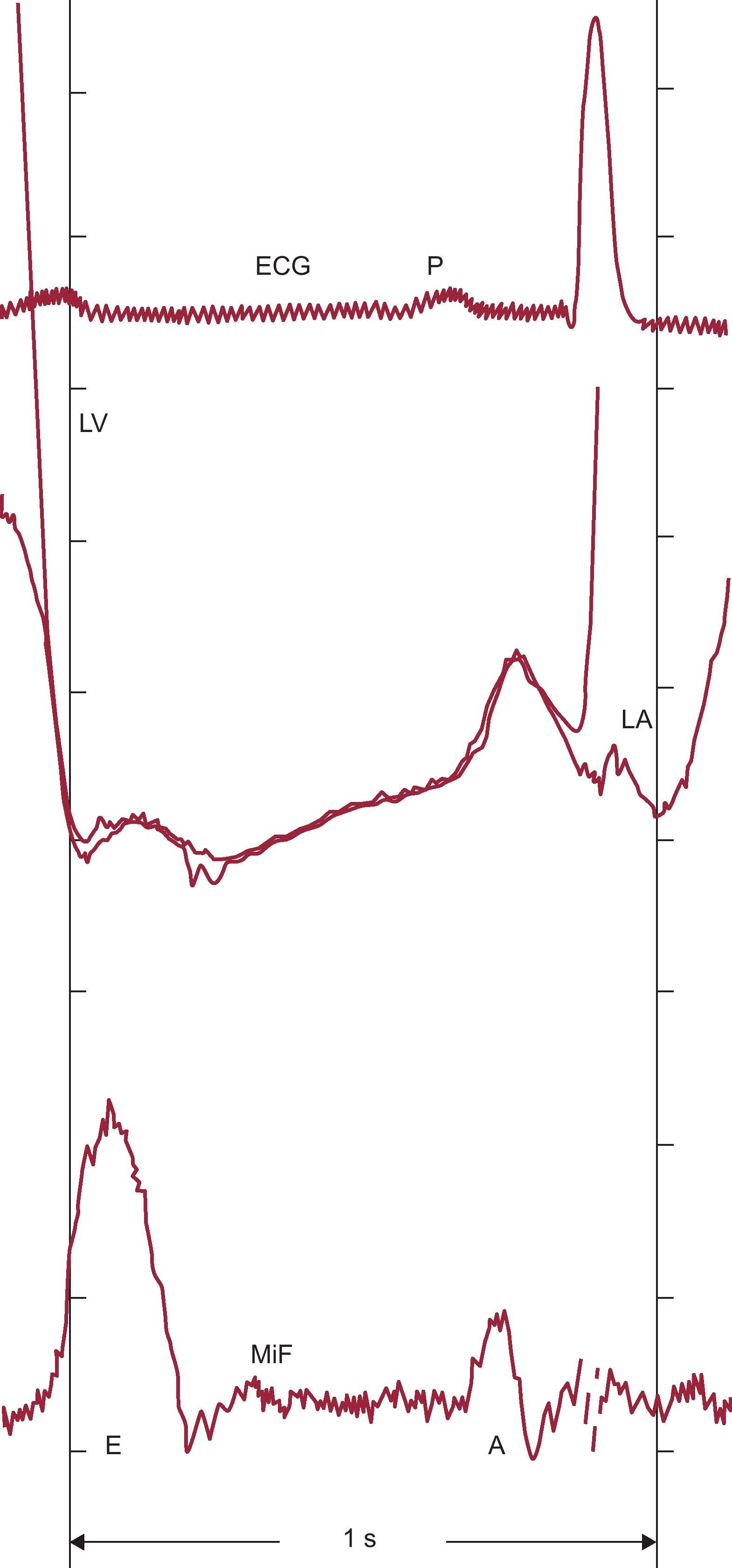 Right and Left Ventricular Diastolic Flow Field: Why Are Measured ...
