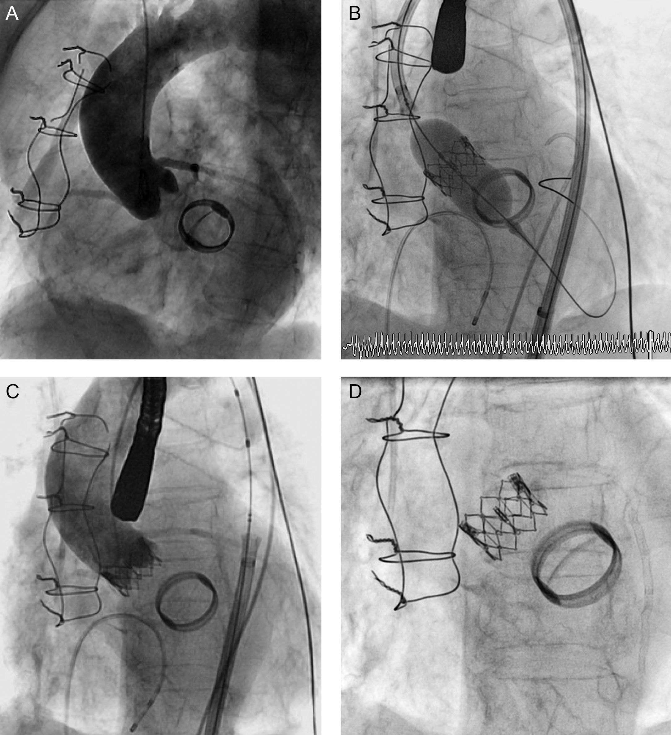 Direct Transfemoral Aortic Valve Implantation in a Patient With a ...