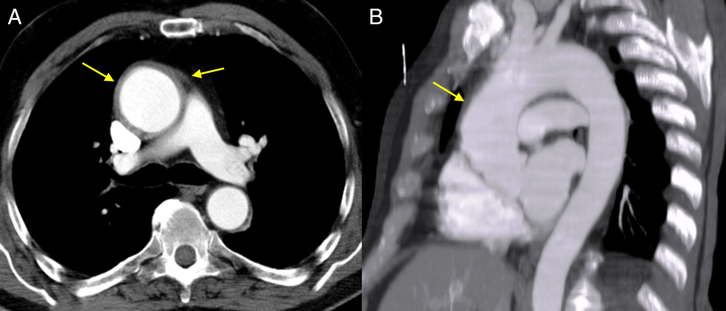 Aortitis: An Unusual Cause of Acute Chest Pain | Revista Española de ...
