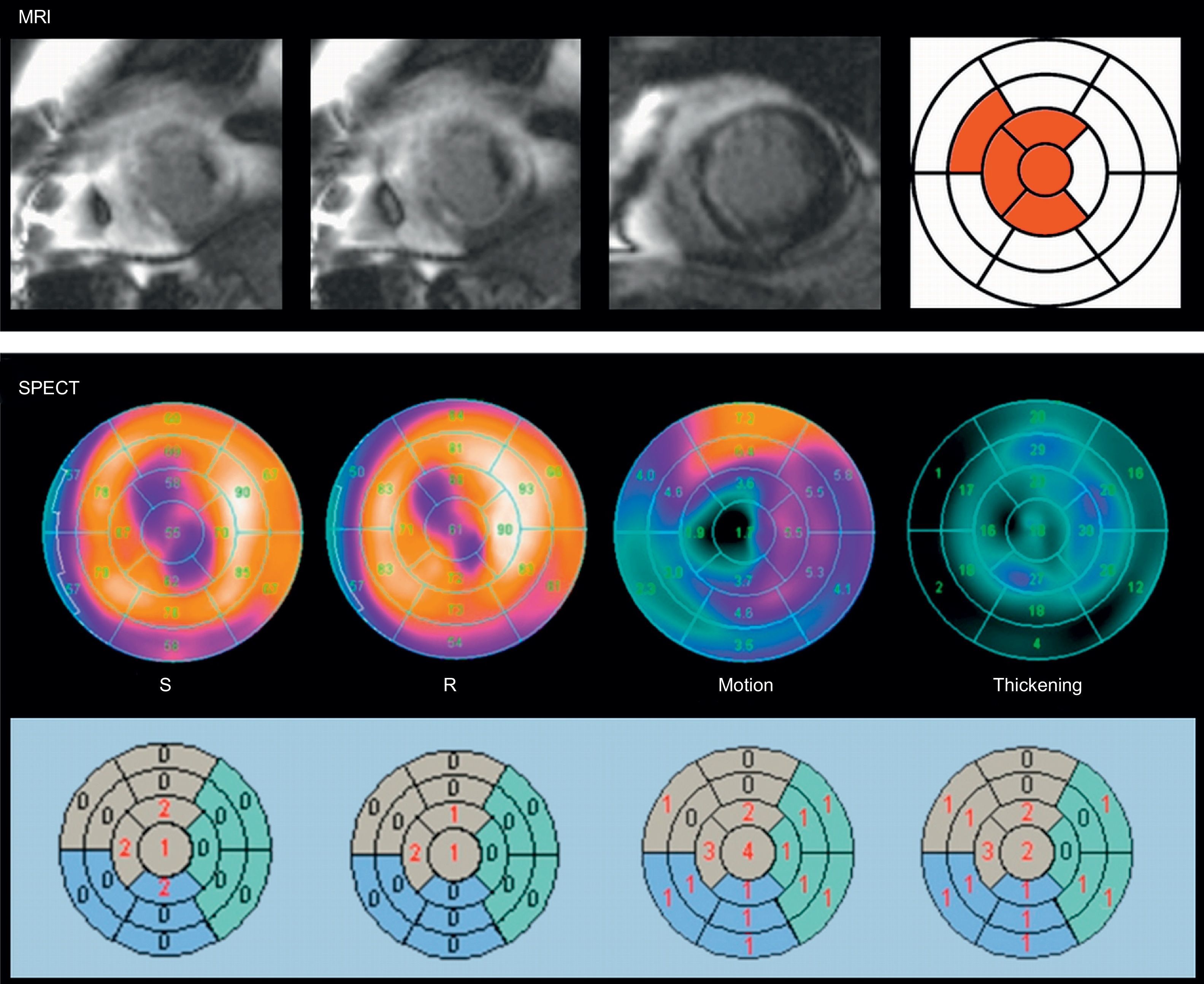 Gated-SPECT Myocardial Perfusion Imaging as a Complementary Technique ...