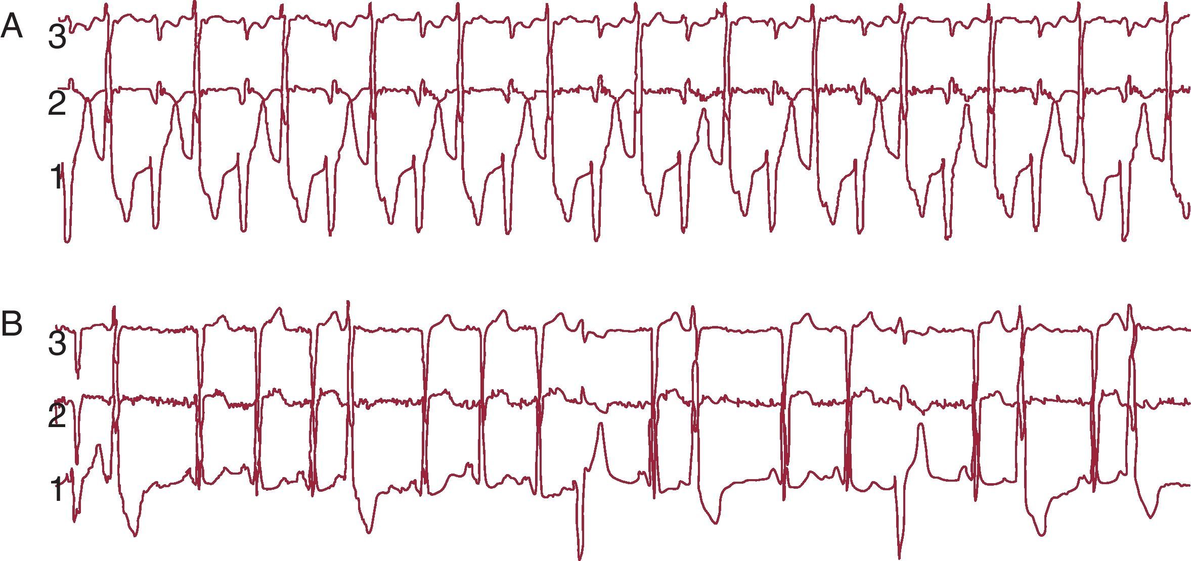 Atypical Bidirectional Ventricular Tachycardia | Revista Española de ...