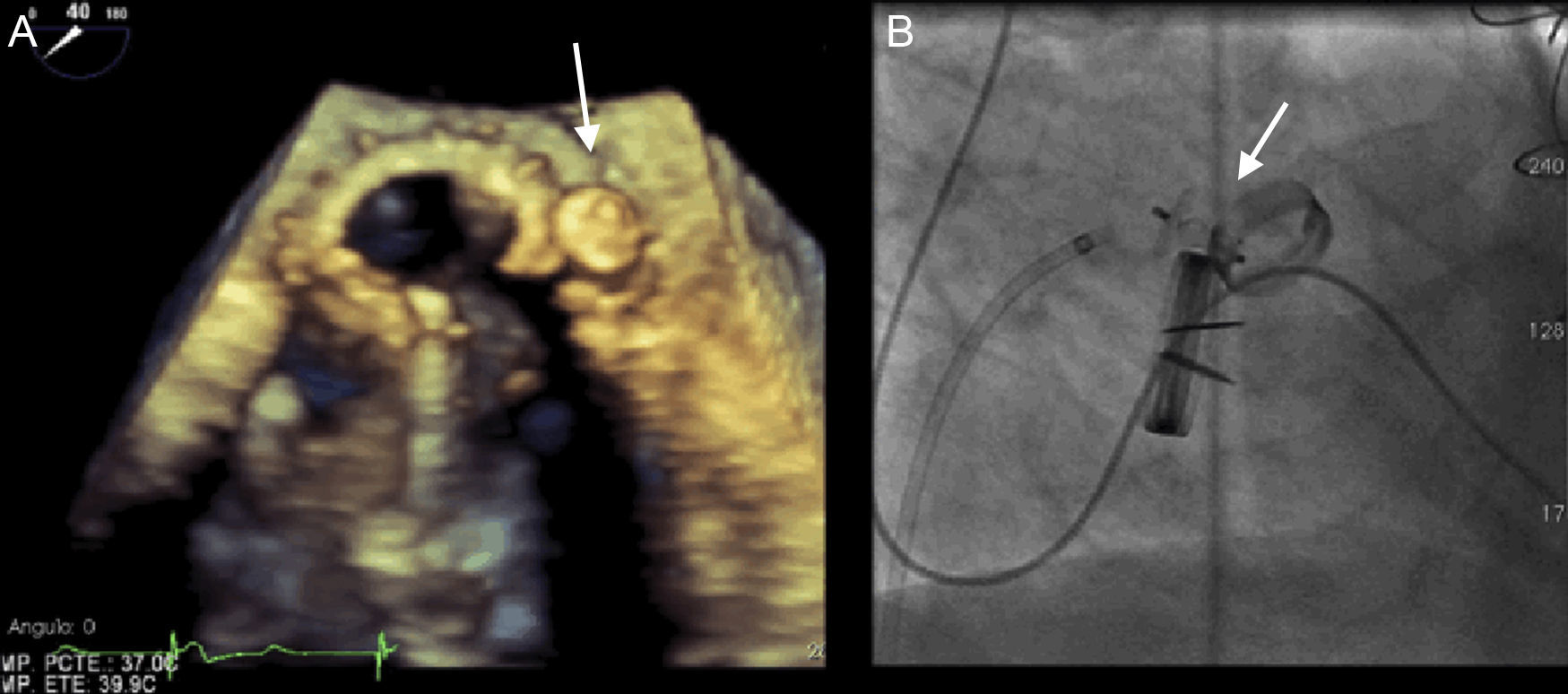 Paravalvular Leak Closure With the Amplatzer Vascular Plug III Device ...