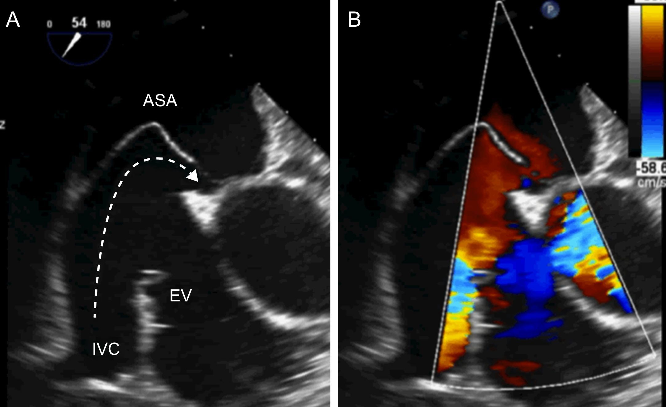 High Risk Pfo Features Rope Current Indications for Percutaneous Closure of Patent Foramen Ovale ...