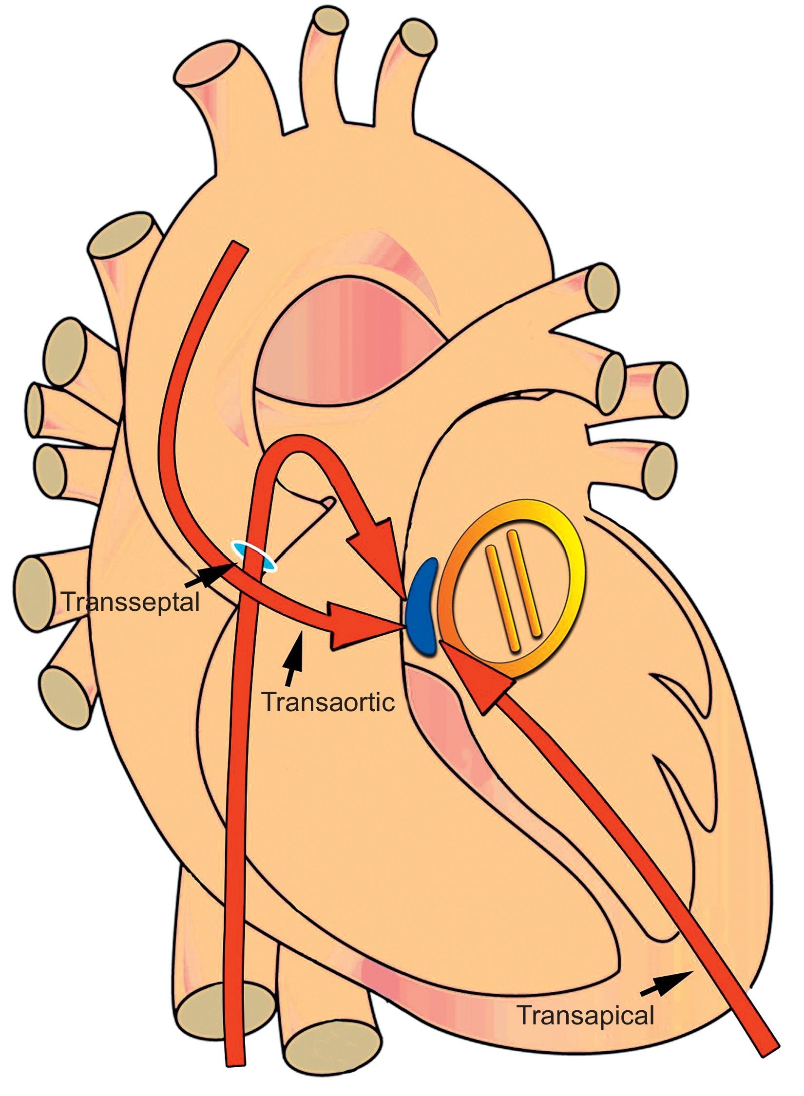 Rethinking Percutaneous Paravalvular Leak Closure: Where Do We Go From ...