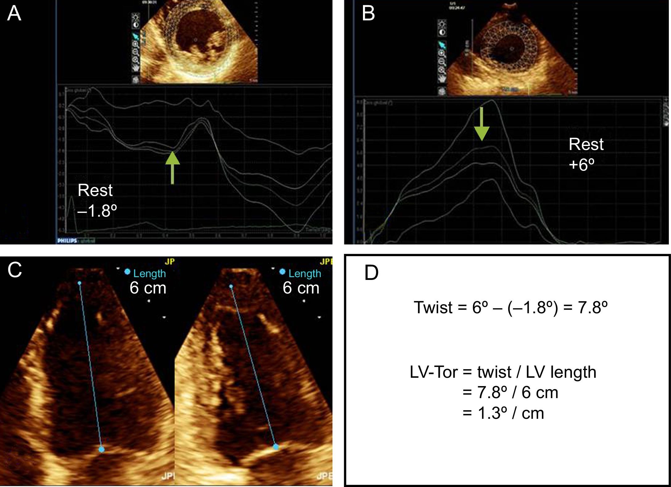 Left Ventricular Torsion During Exercise in Patients With and Without ...