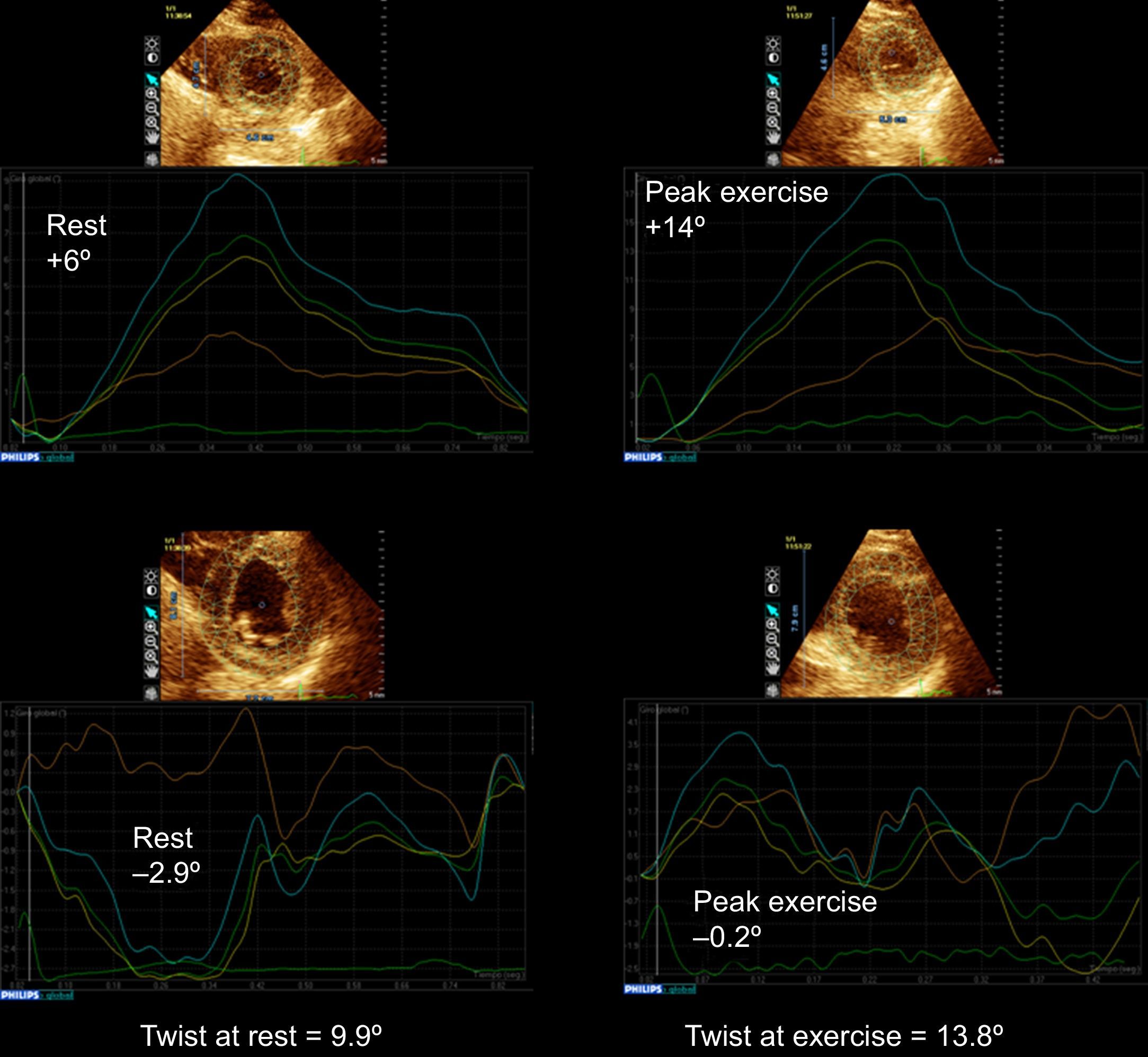 Left Ventricular Torsion During Exercise in Patients With and Without ...
