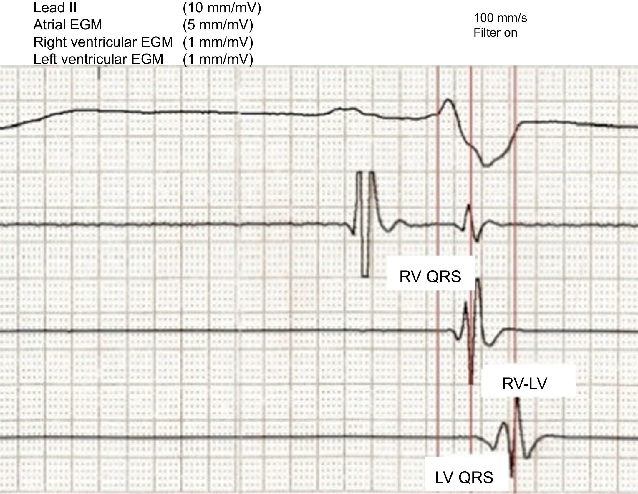 Value of Intraoperative Electrical Parameters Obtained During ...