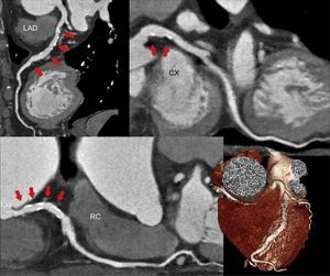 Cardiac CT indicates that the diffuse disease has a prognosis similar to that of obstructive disease. Multiplanar and volumetric reconstructions. Cardiac CT, cardiac computed tomography; RC, right coronary artery; CX, circumflex artery; LAD, left anterior descending artery.