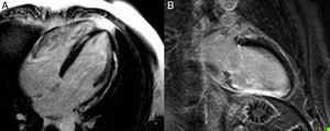 Pattern of lateral and septal subepicardial late enhancement (A) and inferior transmural late enhancement (B) in patients hospitalized for sustained monomorphic ventricular tachycardia. Localization of the fibrosis/necrosis enables planning of the access route for tachycardia ablation treatment.