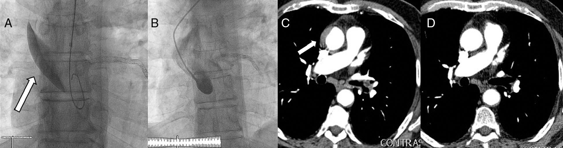 Type A Iatrogenic Aortic Dissection Following Catheterization Without ...
