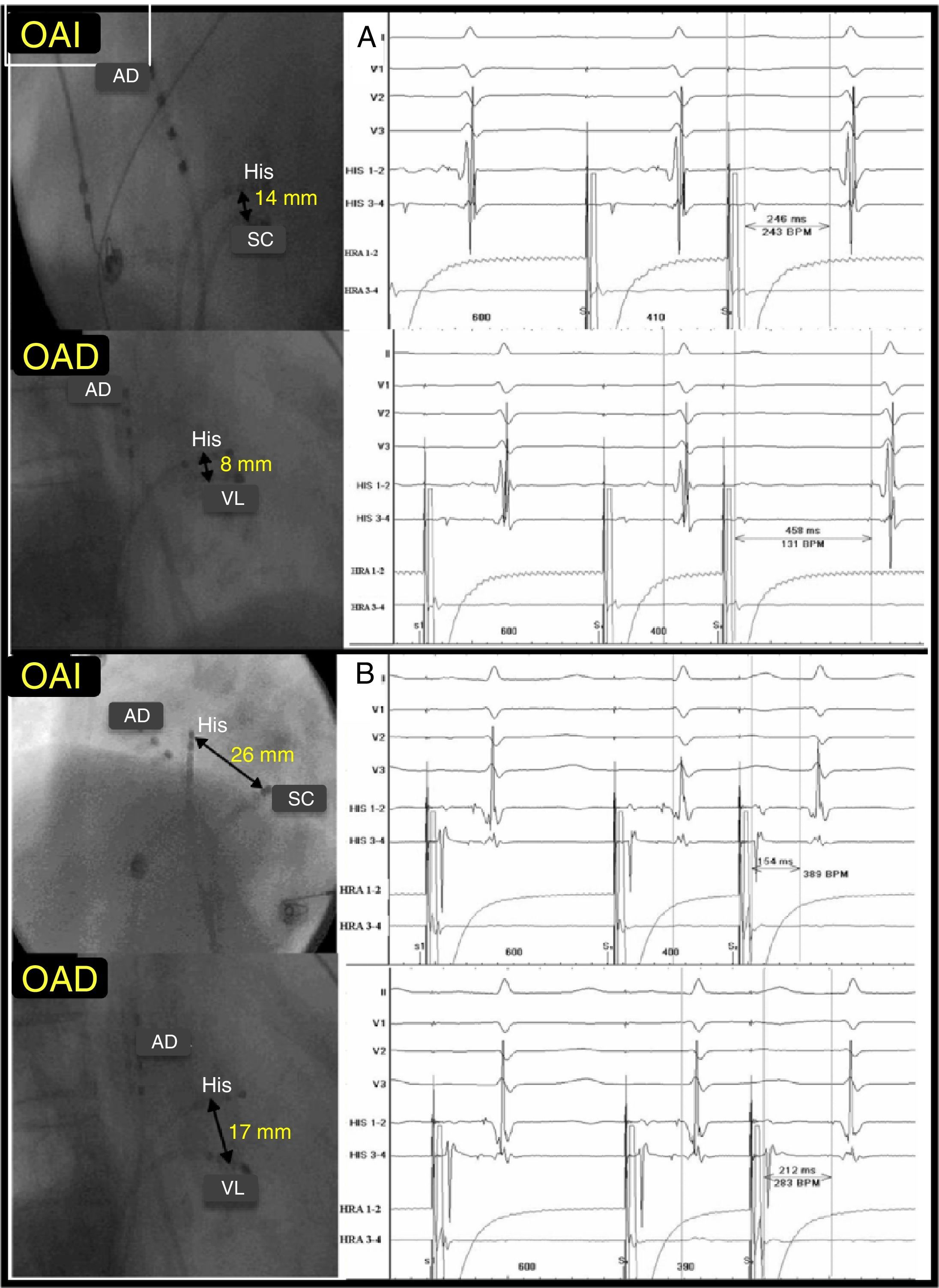 Characterization of the Nodal Slow Pathway in Patients With Nodal ...