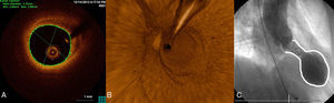 Typical imaging findings. A: optical coherence tomography examination of the left anterior descending artery in 1 case. Image taken at the midarterial level shows an adequate minimal lumen area (5.82mm2). Note the atherosclerotic plaque on the vessel wall, particularly at the 11 to 4 o’clock position, which does not affect the lumen. B: 3-dimensional optical coherence tomography reconstruction in approximately the same area. There are no obstructive lesions or plaque rupture along the length of the vessel. The guideline image is seen at approximately 12 o’clock and the vessel ostium at the bottom. C: ventriculography in systole shows the typical “octopus trap” shape (“tako-tsubo” in Japanese).