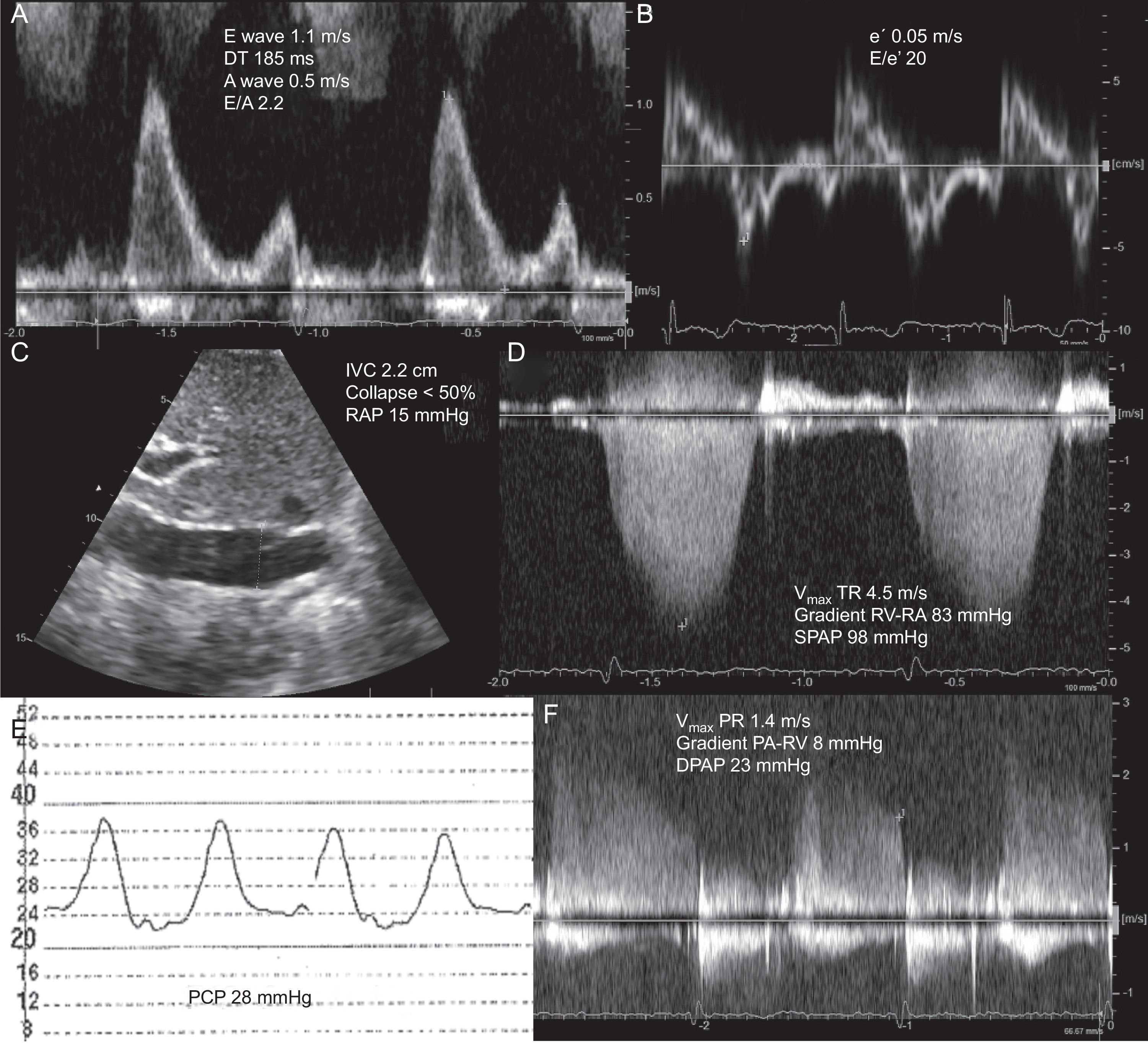Imaging Techniques in Acute Heart Failure - Revista Española de ...