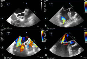 Transesophageal study in a patient with Berlin Heart Excor® biventricular assist device with aortic valve cerclage. A: short axis of aortic valve. B: cannula positioned in the apex of the left ventricle with no evidence of adjacent thrombosis. C: color Doppler at the level of the mitral valve showing severe (IV/IV) functional mitral regurgitation due to annulus dilatation. After adjusting the device parameters, the mitral regurgitation was partially corrected (D).