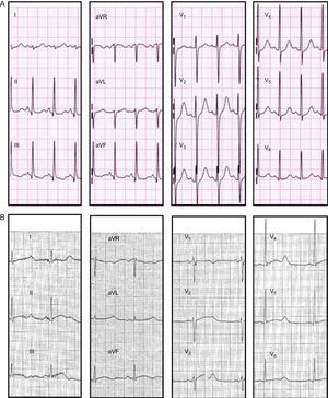 Twelve-lead electrocardiogram of some KCNH2-H562R carriers. A: patient V.1 (QTc 480ms). B: patient IV.12 (QTc, 600 ms). Both reported several episodes of syncope at rest.