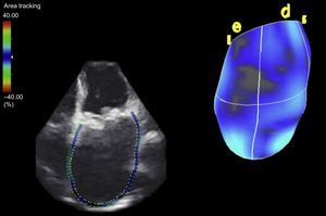 Quantification of left atrial volume by 3-dimensional transthoracic echocardiography.