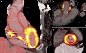 Fusion positron emission tomography/computed tomography images with 18F-fluorodeoxyglucose of patients with endocarditis. A, pacemaker lead; B, Bentall procedure. C, mechanical aortic prosthesis.