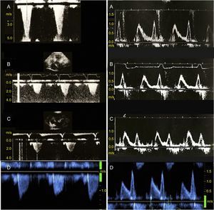 Obstructive gradient of the left ventricular outflow tract (left panels) and transmitral Doppler flow imaging (right panels) in a patient with obstructive hypertrophic cardiomyopathy treated with sequential atrioventricular pacing and followed up for 18 years. A: baseline; B: 6-month follow-up; C: 12-month follow-up; D: final follow-up. Follow-up imaging revealed a permanent reduction in the obstructive gradient of the left ventricular outflow tract (left) and no progression in the baseline diastolic dysfunction (right, A).