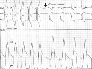 Simultaneous recording of left ventricular and aortic pressures in a patient with left ventricular outflow tract obstruction during sequential atrioventricular pacing and after pacing cessation. During atrioventricular pacing, the dynamic gradient disappears, the peak left ventricular pressure decreases, and the central aorta pressure increases, which improves cardiac output. Ao, aorta; AV, atrioventricular; LV, left ventricle.