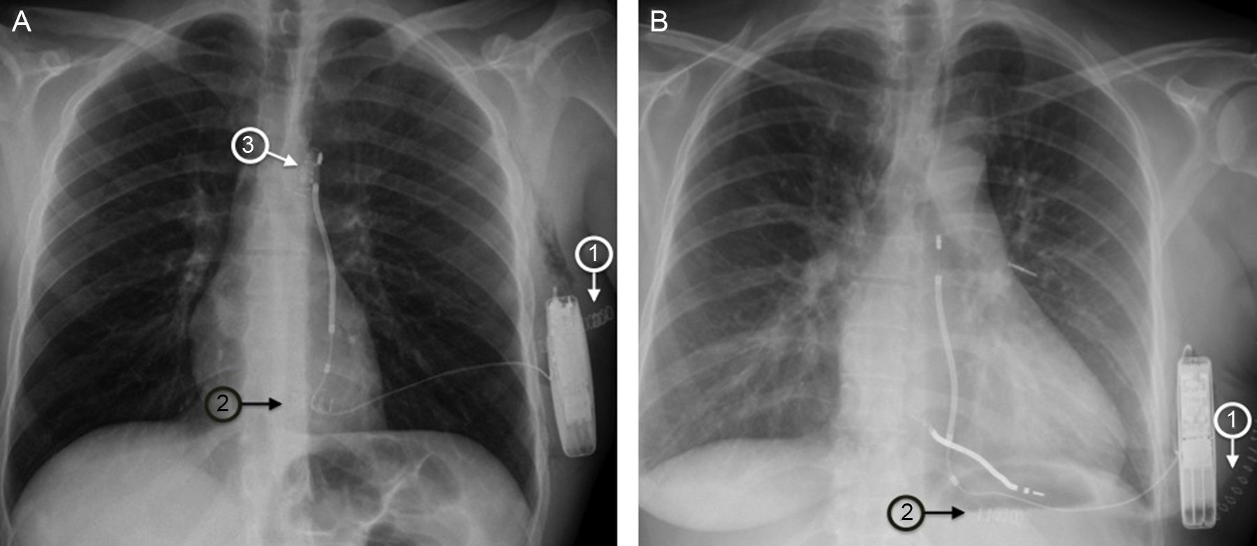 Racket Incision Ray Two-incision Technique for Subcutaneous Cardioverter-defibrillator ...