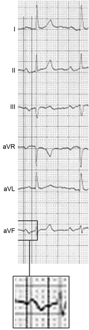 Electrocardiogram showing advanced interatrial block: P wave ≥ 120ms plus a ± pattern in the II, III, and aVF leads.