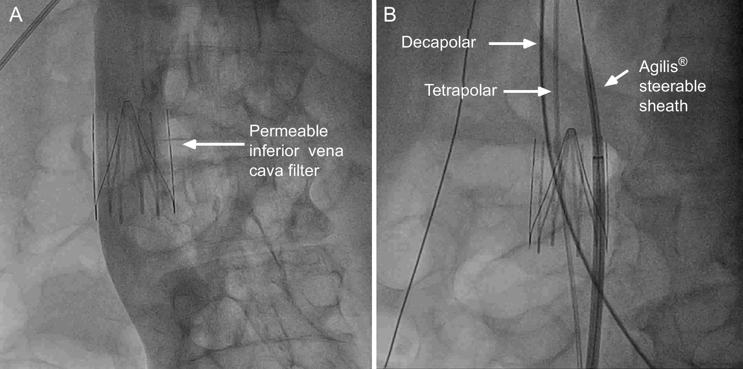 Ventricular Tachycardia: Inferior Vena Cava Filter in a Case of ...
