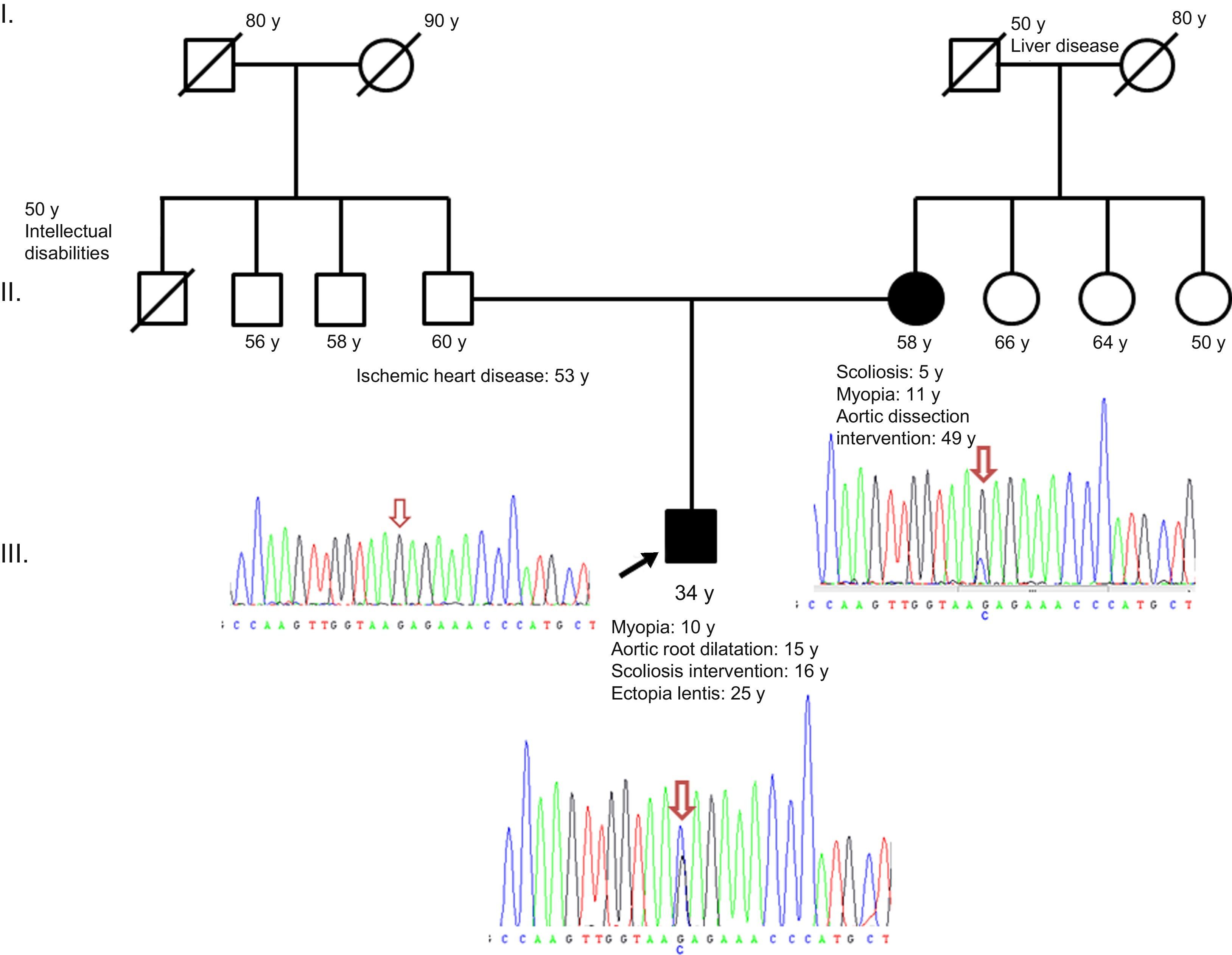 Marfan Inheritance Pattern Marfan Syndrome Caused by Somatic Mosaicism in an FBN1 Splicing ...