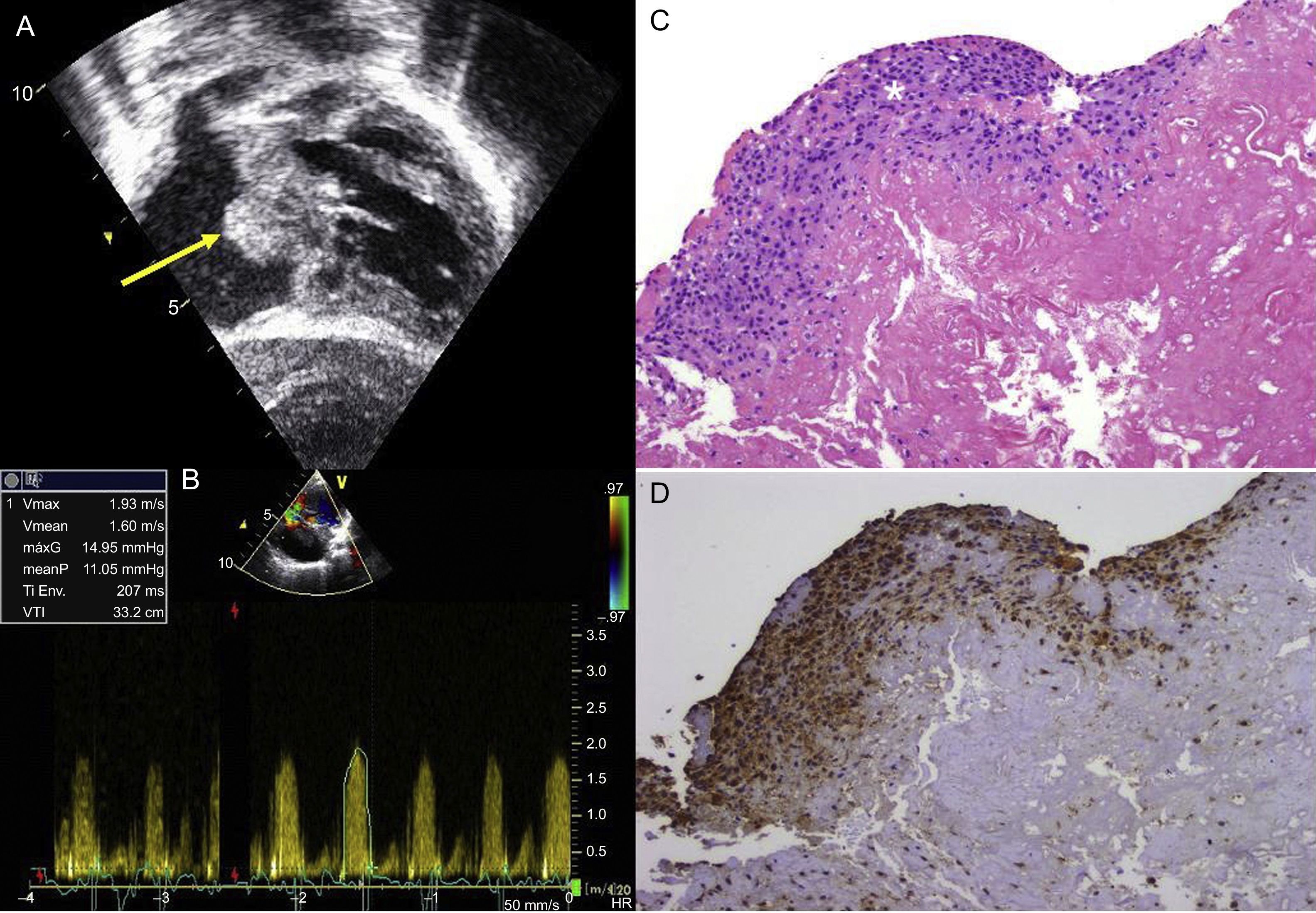 Correction of Congenital Cardiac Defects With CorMatrix Extracellular ...