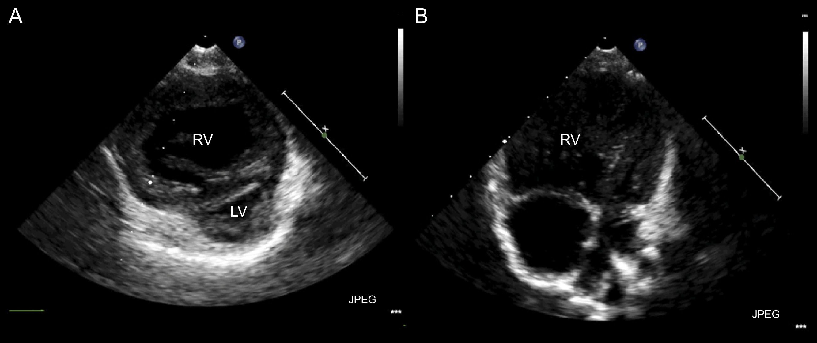 Pulmonary Arterial Hypertension and Neonatal Arterial Switch Surgery ...
