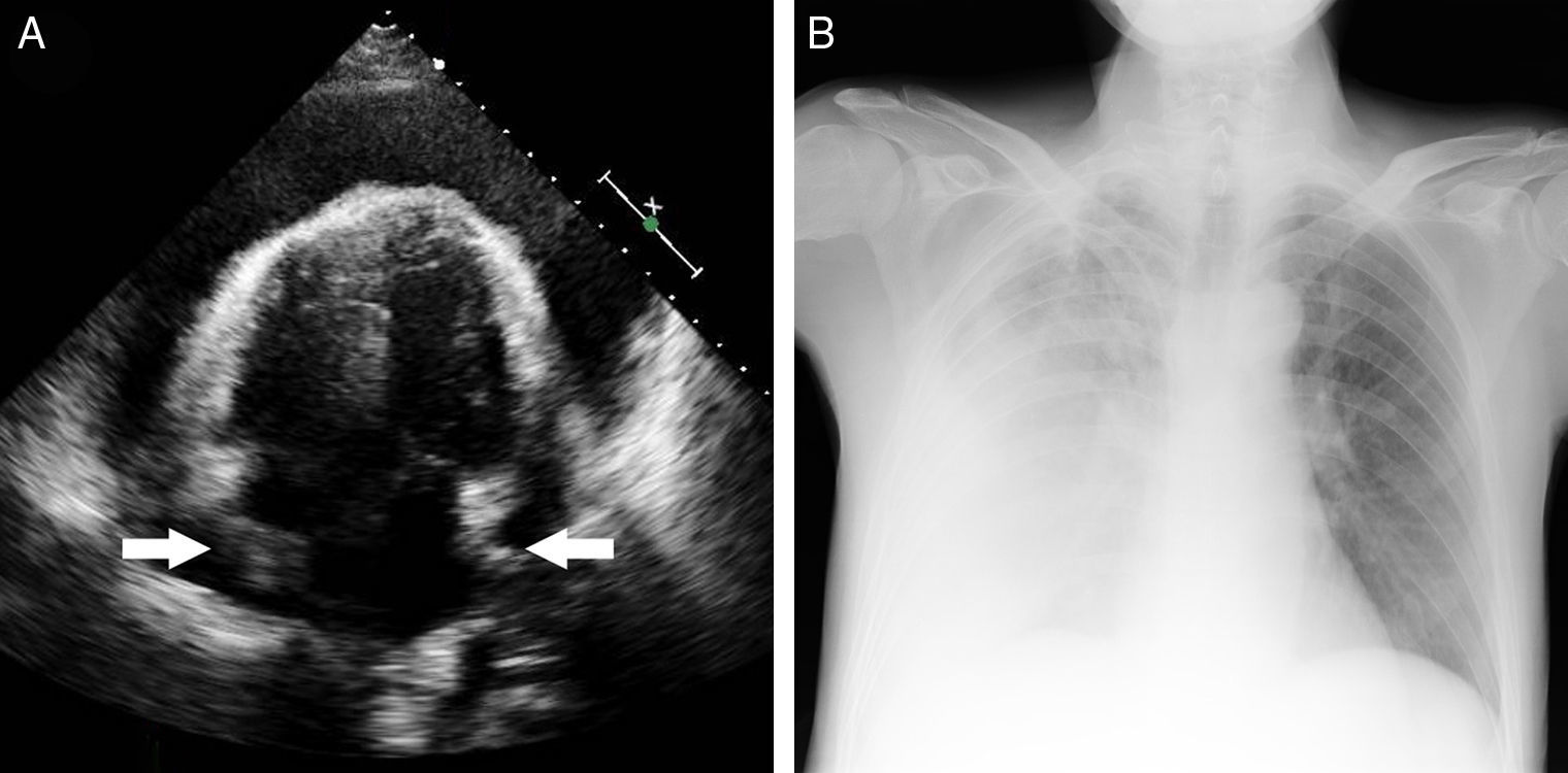 Recurrent Pericarditis as the Presenting Form of Adult Still's Disease