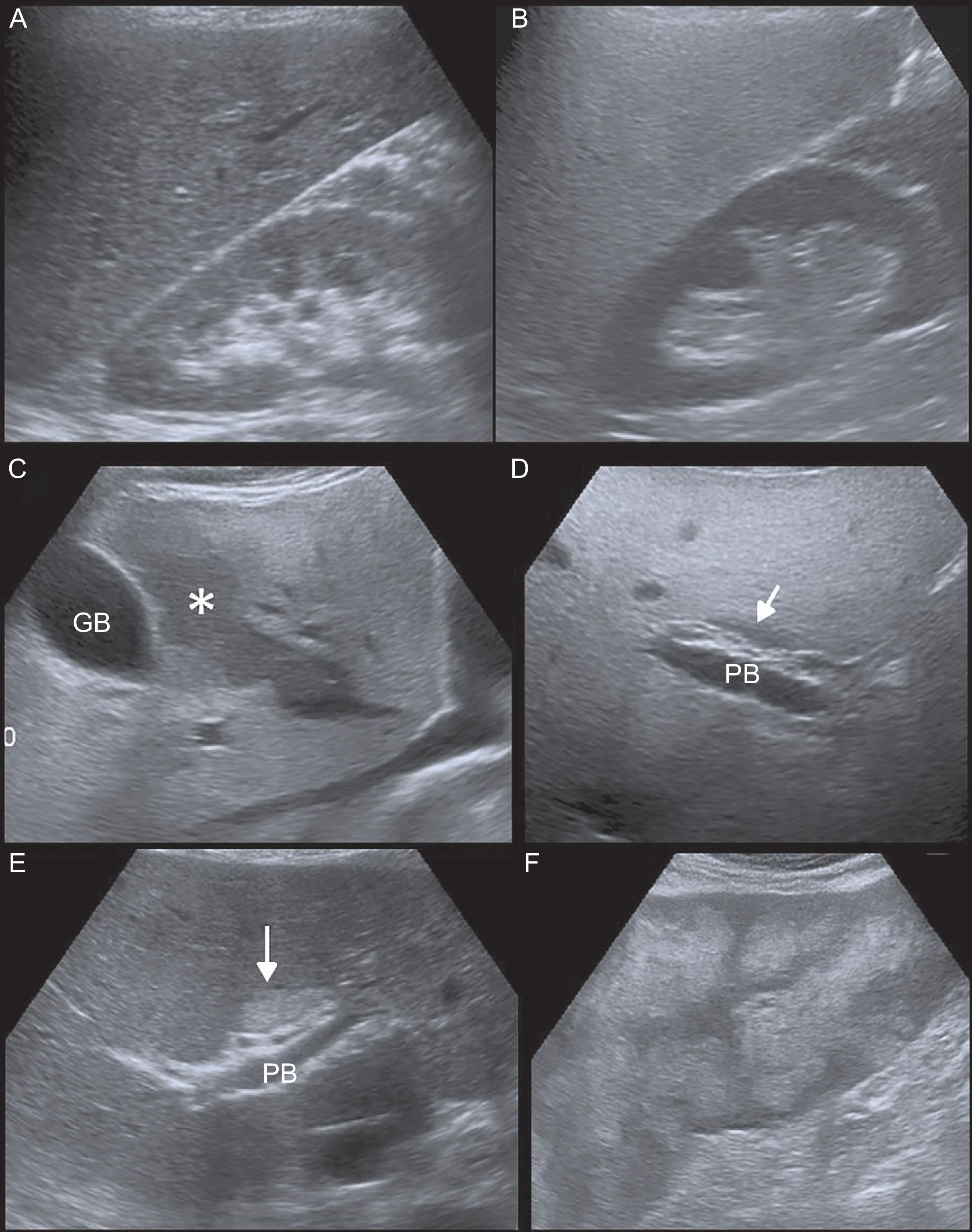 Echo Pattern Liver and Cardiovascular Disease: What Cardiologists Need to Know About ...