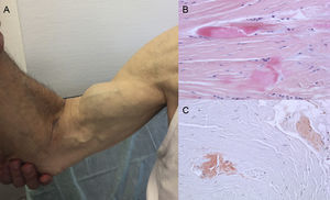 Signs and symptoms of transthyretin amyloidosis. A: nontraumatic rupture of the right biceps tendon (“Popeye sign”). B and C: staining with hematoxylin-eosin (B) and Congo red (C), both ×200, of carpal ligament sample showing dense collagen bundles with noncellular material. Courtesy of Dr Clara Salas Antón.