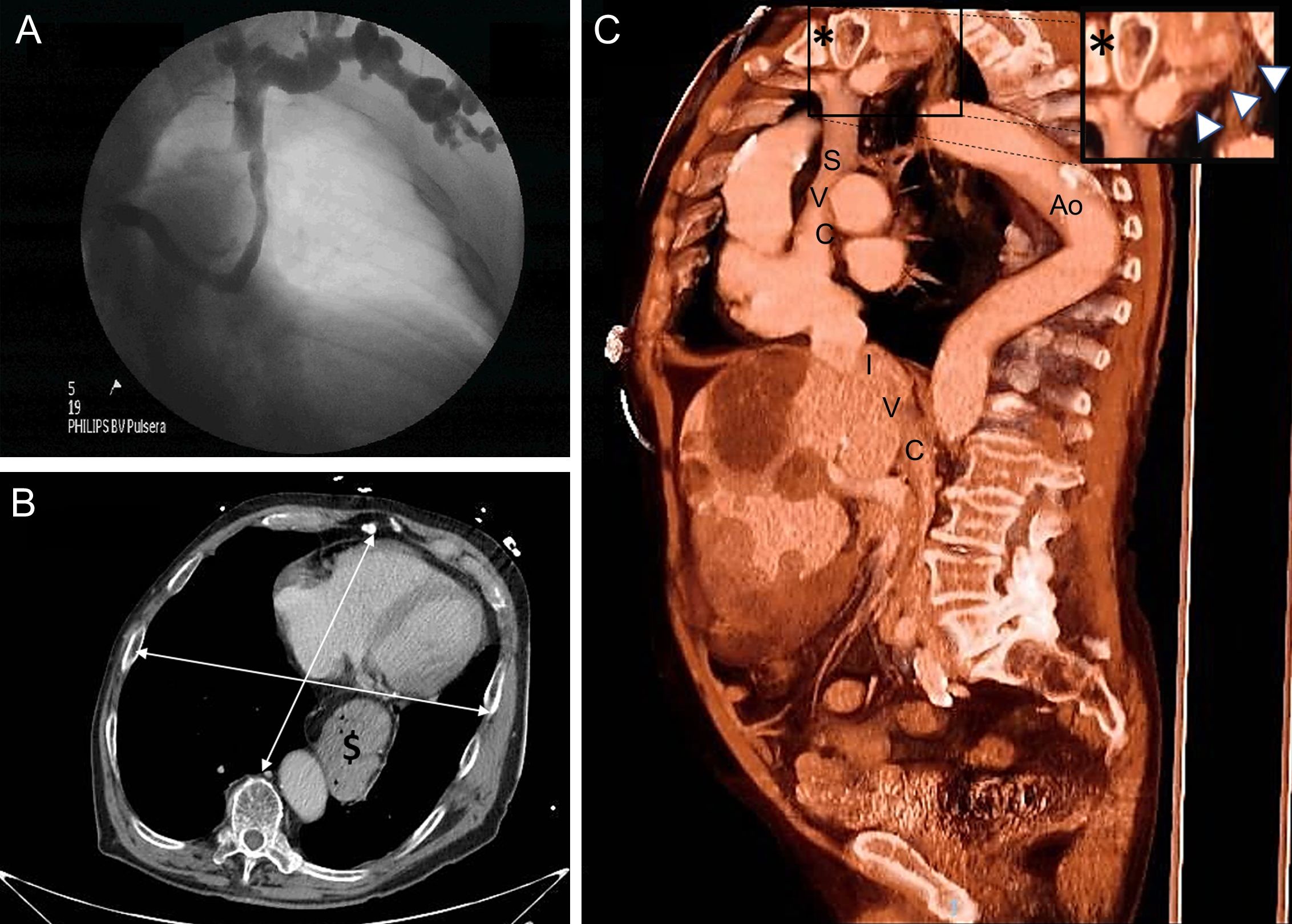 Leadless Pacemaker Implantation in a Patient With a Severe Thoracic ...