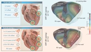 In silico representation of the effect of single-site pacing vs multipoint pacing. Schematic representation of left ventricular (LV) multisite pacing compared with single-site pacing (left panels). The right-sided panels represent an in silico patient-specific three-dimensional (3D) simulation of the activation pattern of the left and right ventricle. In the left upper panel, the conventional single-site LV pacing in combination with conventional right ventricular (RV) pacing is shown, while the right upper panel shows the resulting 3D BV activation map. In the left lower panel, a multipoint LV pacing setting is shown whereby the first LV pace (LVa) immediately precedes the second LV pace (LVb), creating a different activation pattern, depicted in the right lower panel. Multisite LV pacing allows for a better LV electrical synchronization as shown in the 3D simulation. BV, biventricular; CRT, cardiac resynchronization therapy.